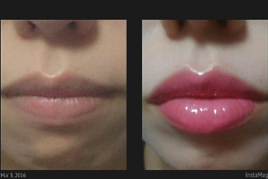 唇のBefore&After